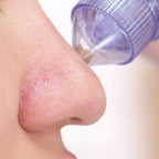 4-in-1 Electric Blackhead Remover – Pore Vacuum Cleaner & Acne Suction Tool
