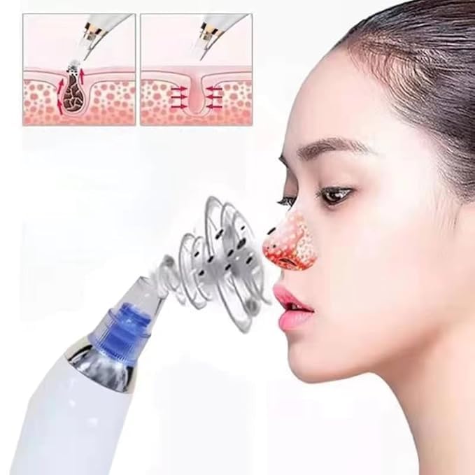 4-in-1 Electric Blackhead Remover – Pore Vacuum Cleaner & Acne Suction Tool
